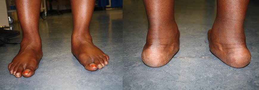 rolfing help someone with flat feet 