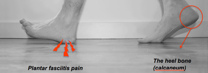 Plantar Fascia Treatment | Private 