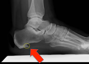 plantar calcaneal spur images