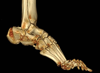 Posterior Calcaneal Spur