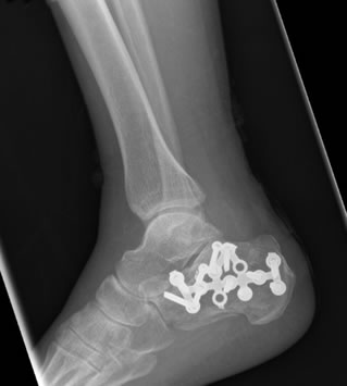 Calcaneum Fracture With Plate