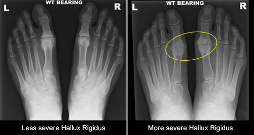 Hallux Rigidus Big Toe Arthritis Private Surgeon London London Foot