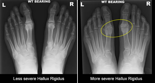 hallux rigidus insoles uk