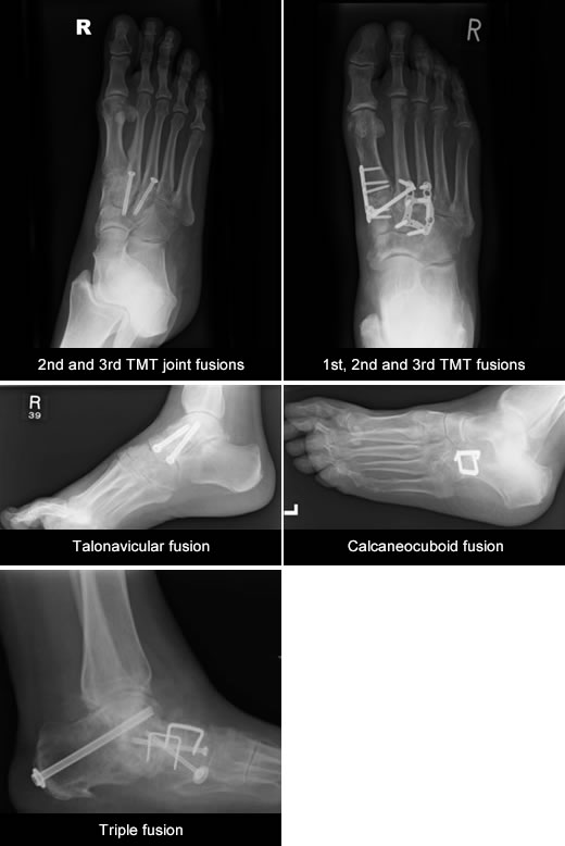 Foot Fusion Xrays