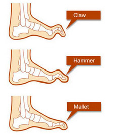 Claw Hammer Mallet Toe