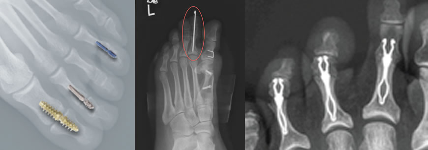 Toe Fusion Surgery
