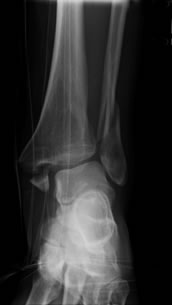 Ankle Fracture Xray