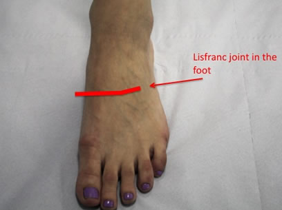lisfranc fracture)