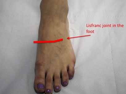 Lisfranc Area