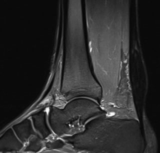 Achilles Mri