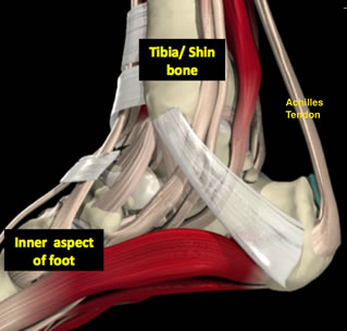 Achilles Tendinitis