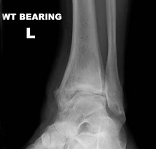 Ankle Arthritis Diagnosis