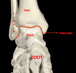 Ankle Arthritis