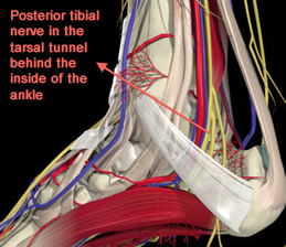 Tarsal Tunnel