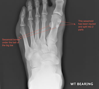 Sesamoid Bone