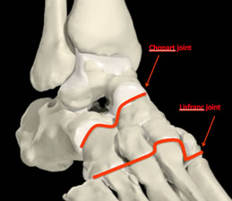 Midfoot Arthritis