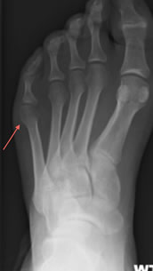 Tailors Bunion Xray