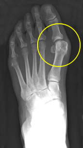 Bunion Xray