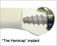 Hemicap