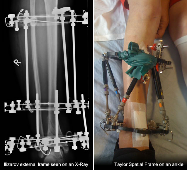 Pilon Fracture Treatments