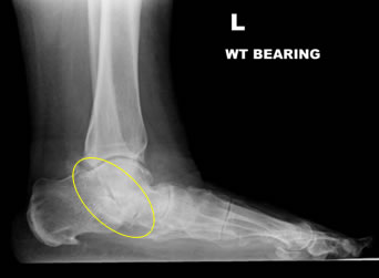 Hindfoot Arthritis Xray