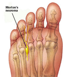 Mortons Neuroma