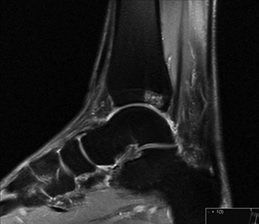 Osteochondral Defect