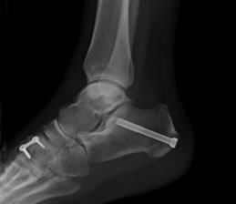 Flat Foot Reconstruction Surgery | Private Surgeon London | London Foot ...