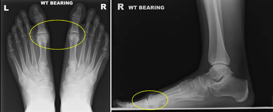 Chylus Ap And Lateral