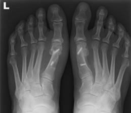 Bunion Surgery