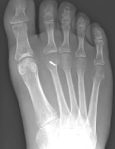 Metatarsal Osteotomy Surgery