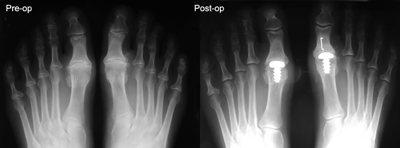 Hallux Mtp Replacement