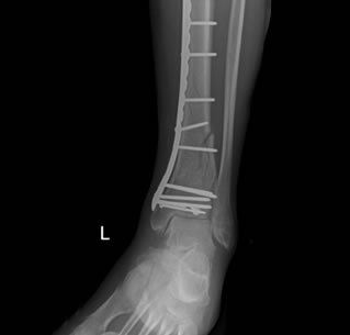 Pilon Fracture Treatment