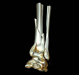 Pilon Fractures