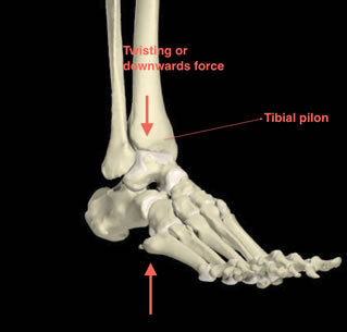 Pilon Fracture