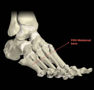 Metatarsal Fracture