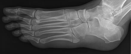 Metatarsal Fracture Xray