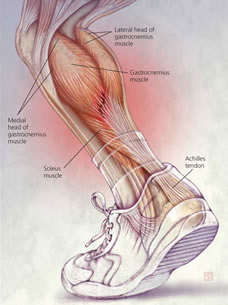 Achilles Tendon