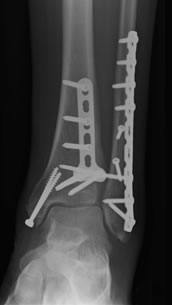 Ankle Fracture Treatment