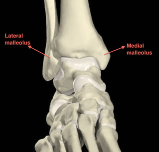 Ankle Fracture