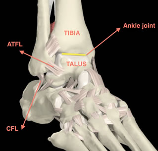 Ankle Sprain