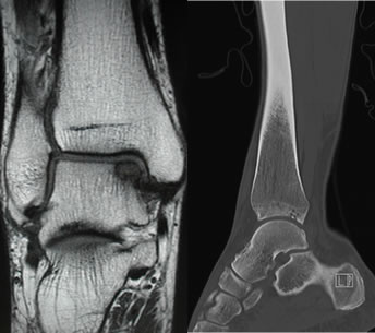 Chromic Ankle Instability