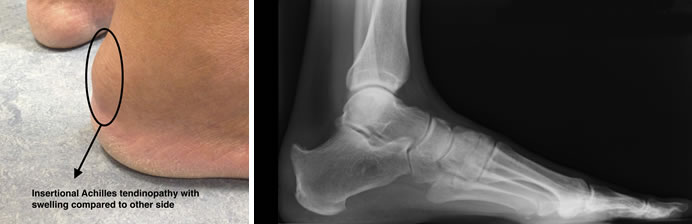 Achilles Tendinopathy Insertional